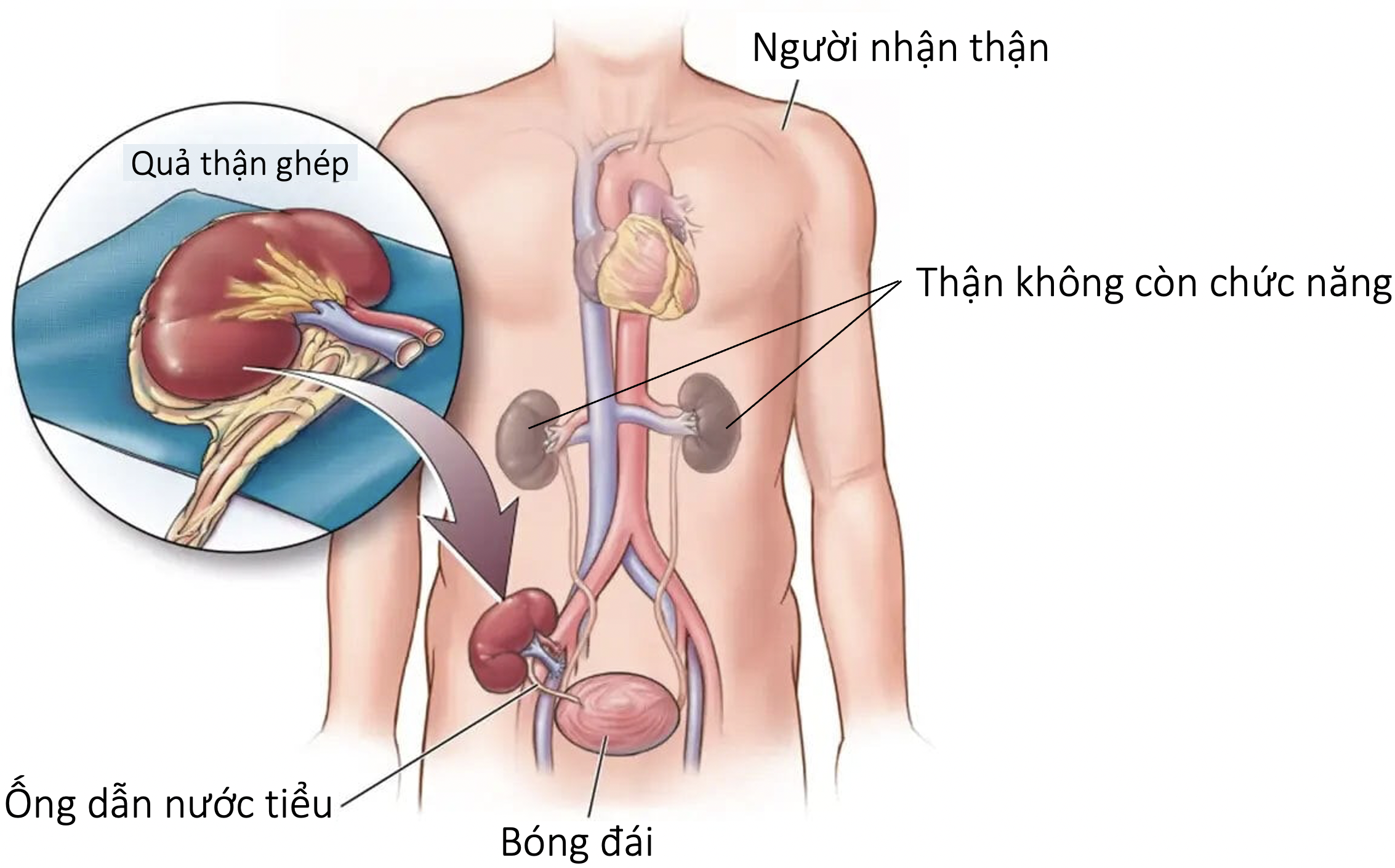 ghép thận 